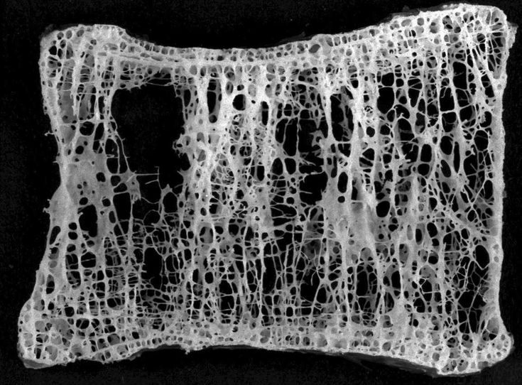 Comparación ilustrada de la estructura de un hueso normal y un hueso afectado por osteoporosis